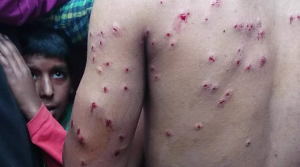 Pellet injuries from Kashmir Freedom Aug 26 2016